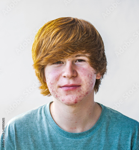 smart boy in puberty with acne photo