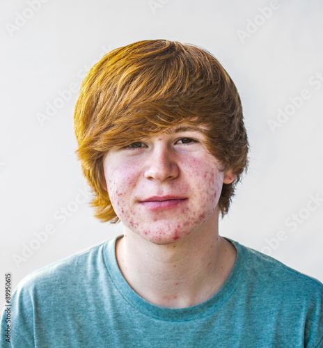 Photos smart boy in puberty with acne