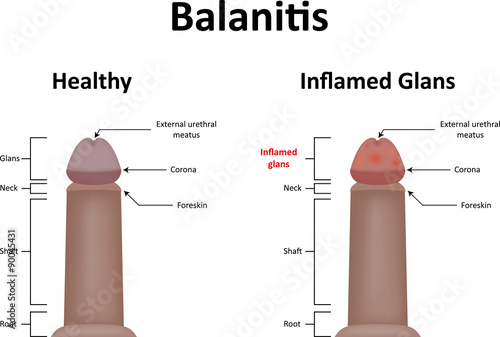 Balanitis Illustration