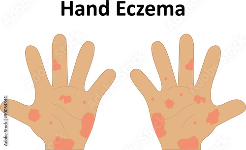 Hand Eczema photo