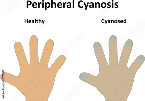 Peripheral Cyanosis