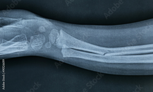 Xray of a broken hand