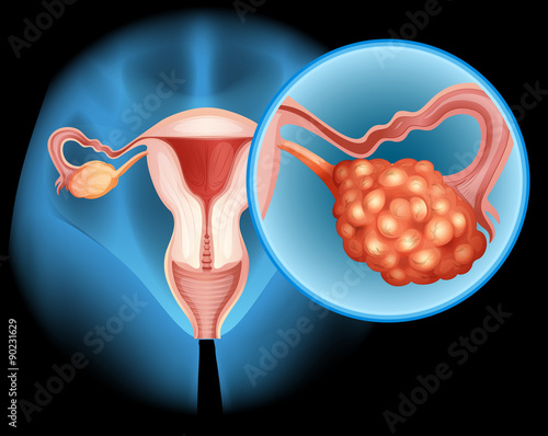 Ovarian cancer diagram in detail