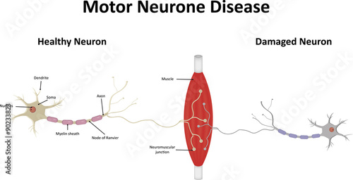 Motor Neurone Disease Illustration