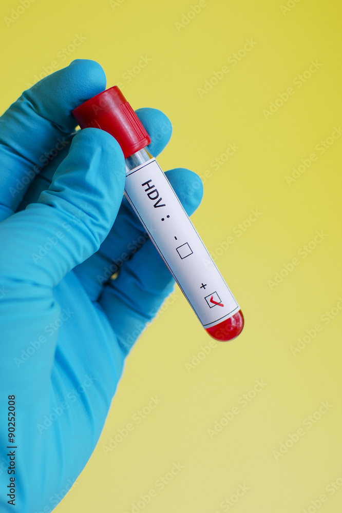 Fototapeta premium Hepatitis D virus (HDV) positive