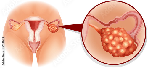 Overian cancer diagram in detail photo