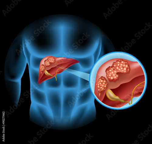 Liver Cancer diagram in detail