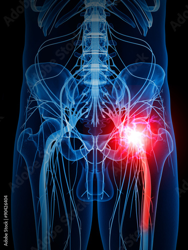 medically accurate illustration of a painful sciatic nerve photo