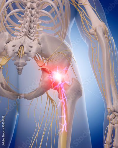 medically accurate illustration of a painful sciatic nerve photo