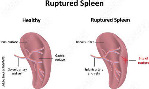 Ruptured Spleen Illustration