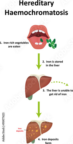 Hereditary Haemochromatosis Pathophysiology photo