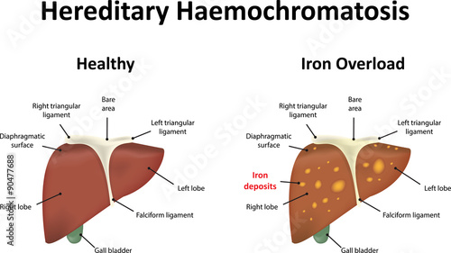 Hereditary Haemochromatosis