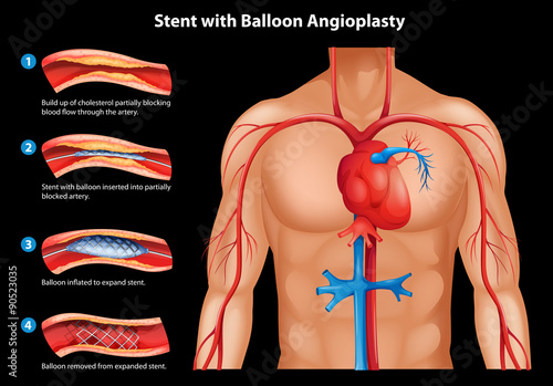 Stent with balloon Angioplasty