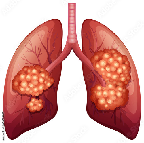 Lung cancer process in detail