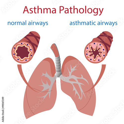 vector illustration of lungs and airways. Normal and asthmatic.