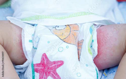 Obraz na płótnie Irritant diaper dermatitis