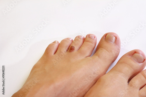 Female leg fingers with birthmark, beautiful female feet
