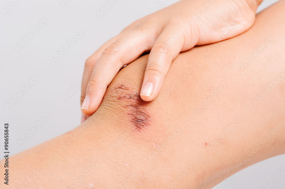 Wound on child knee from accident become dry Wound on child knee from accident become dry