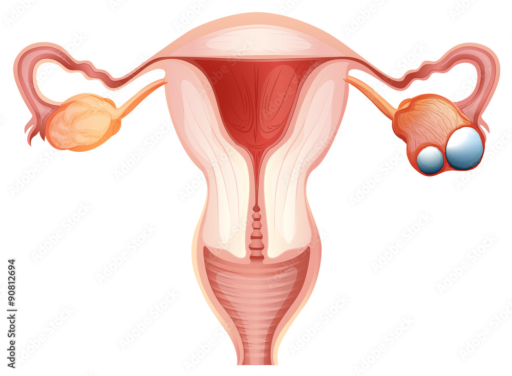 Naklejka premium Ovarian cancer diagram in woman