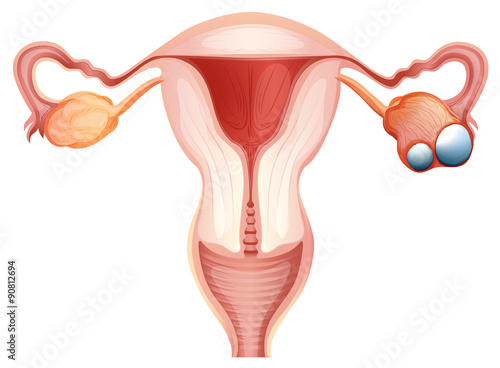 Ovarian cancer diagram in woman