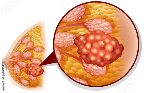 Breast cancer on white