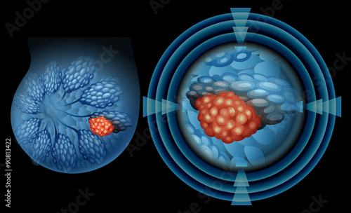 Position of breast cancer.