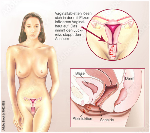 Konstfotografi Pilzinfektion im Vaginalbereich