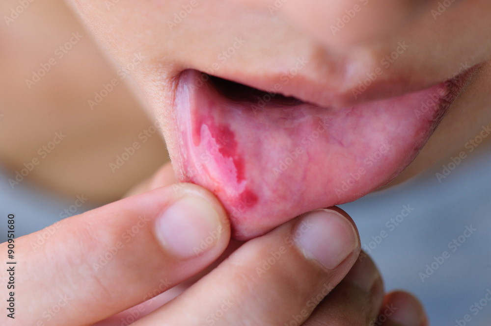 Naklejka premium Woman show her lower lip of the mouth with injury