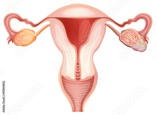 Ovarian cancer in woman