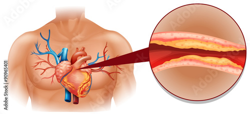 Cholesterol in human heart