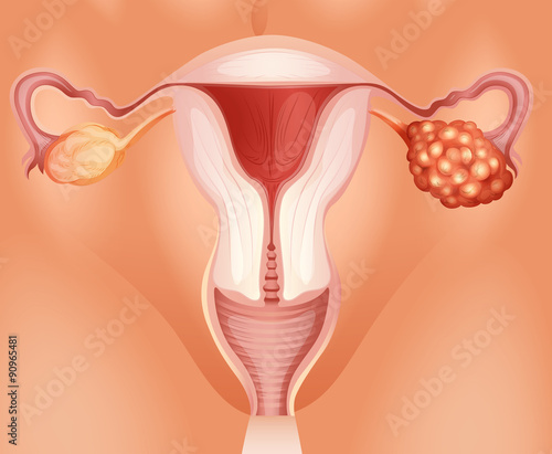 Ovarian cancer in woman photo