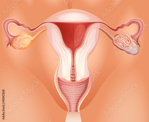 Ovarian tumor in woman