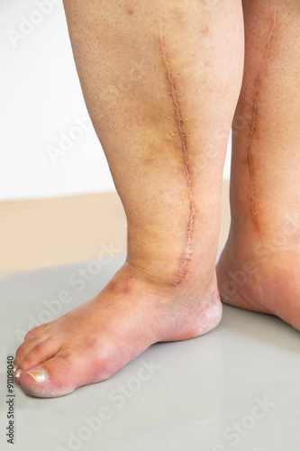 Human leg with postoperative scar of cardiac surgery