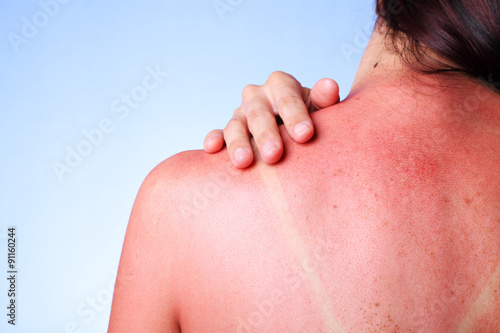 A female touching her sunburned shoulder photo