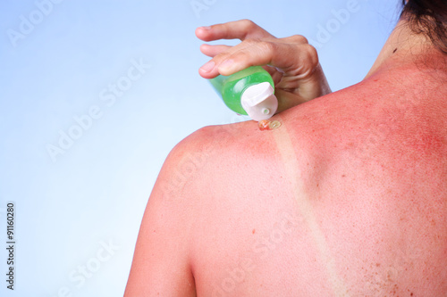 Woman applying Aloe Vera gel on her sunburned shoulder