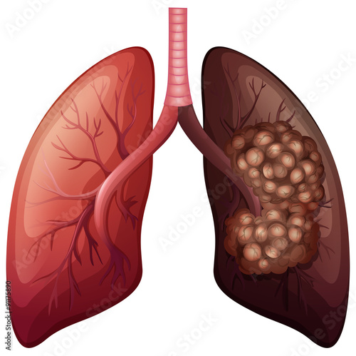 Normal lung and lung cancer