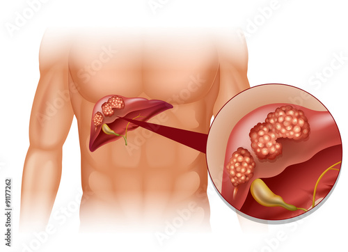 Liver cancer in human