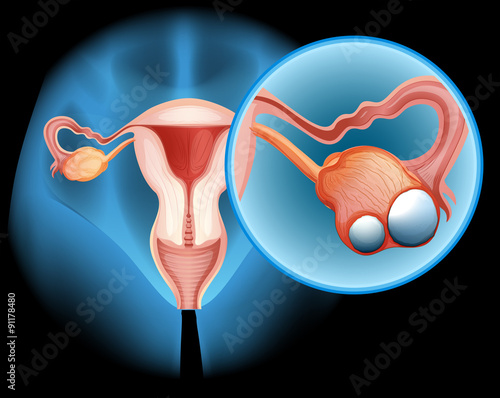 Ovarian cancer in human