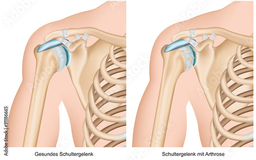 Arthrose in der Schulter, Omarthrose