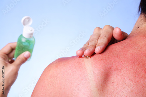 Woman rubbing aloe vera gel on her sunburned shoulder