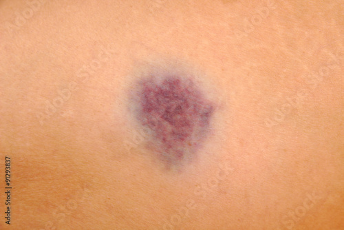 Close up of bruise on wounded woman leg skin. Gender violence