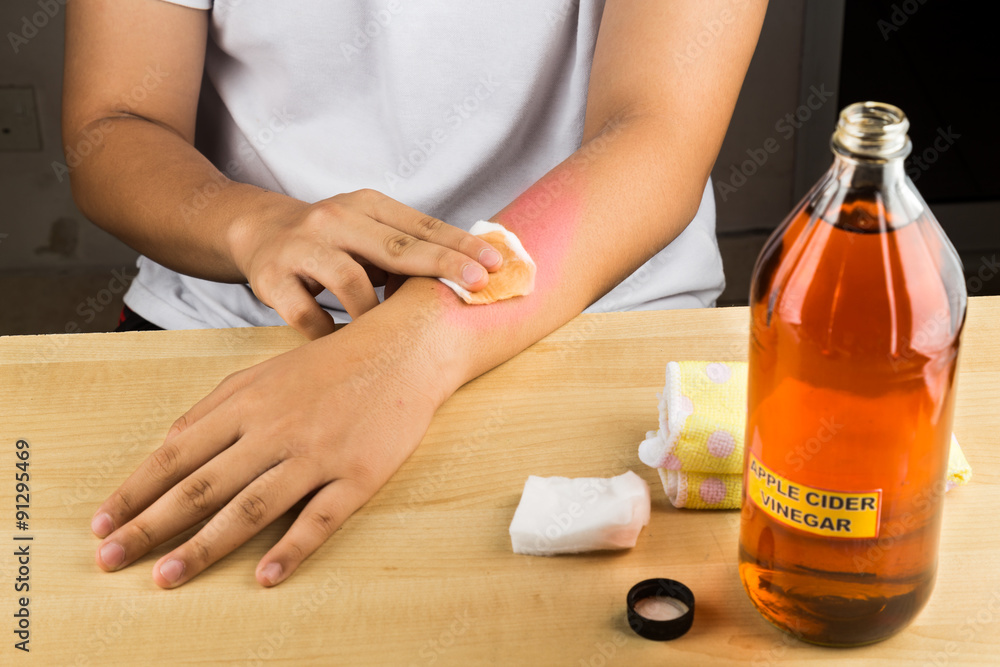 Apple cider vinegar effective natural remedy for skin itch, fungal