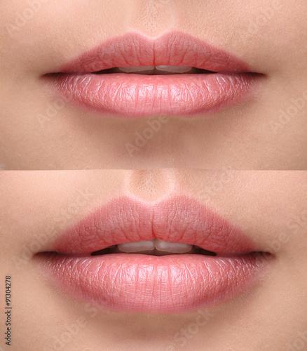Canvas Print Sexy plump lips after filler injection