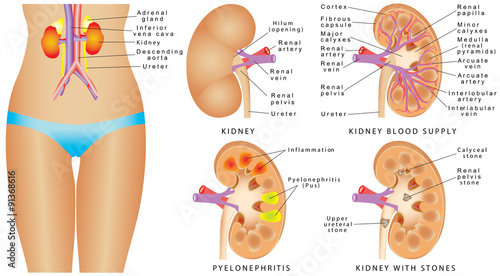 Human kidney anatomy. Normal human kidney and cross section of the kidney, blood supply. Human kidneys with veins and  arteries. Kidney with stones. Kidney Chronic pyelonephritis