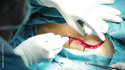 Start of operation. The surgeon performs incision in the patient's body. The surgeon cuts with a scalpel. photo