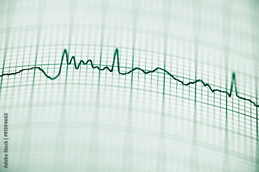 Electrocardiogram Electrocardiogram