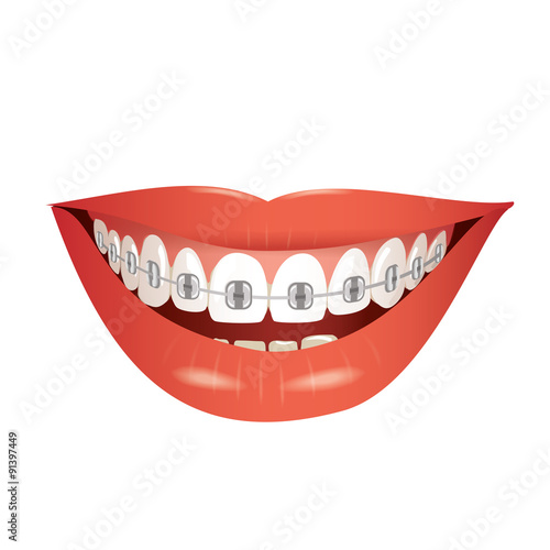 smiling mouth with braces isolated  vector illustration