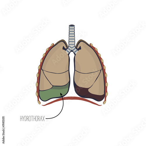 Accumulation of fluid in the pleural cavity of the lungs