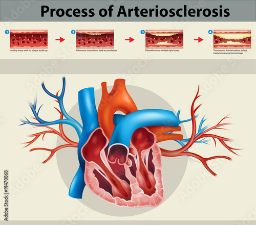 Poster of process of artriosclerosis