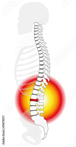 Spinal disc herniation or prolapse at a human vertebral column - profile view. Isolated vector illustration on white background.